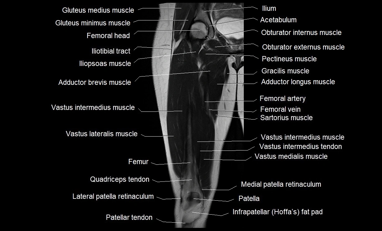 MRI thigh coronal cross sectional anatomy image 9.webp
